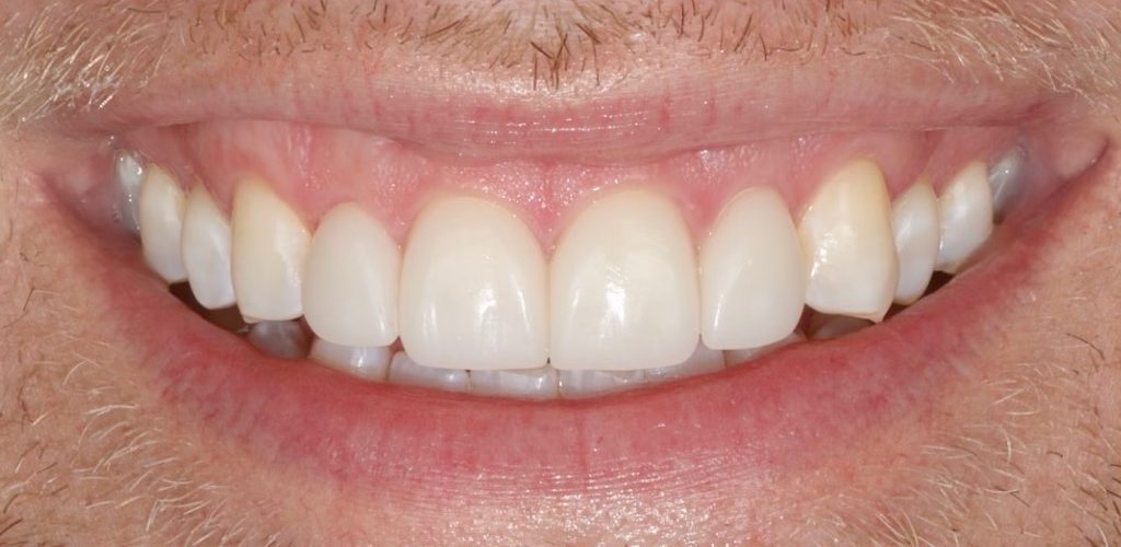 4 Porcelain Veneers — after (actual patient)