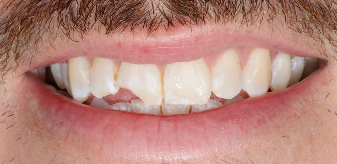 Composite Bonding — before (actual patient)
