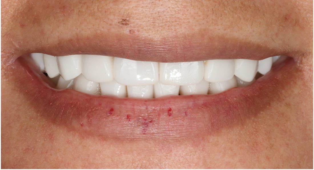 Full Mouth Rehabilitation 2 — after (actual patient)
