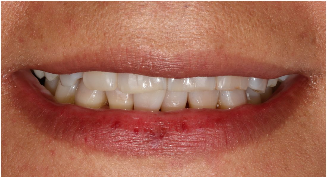 Full Mouth Rehabilitation 2 — before (actual patient)