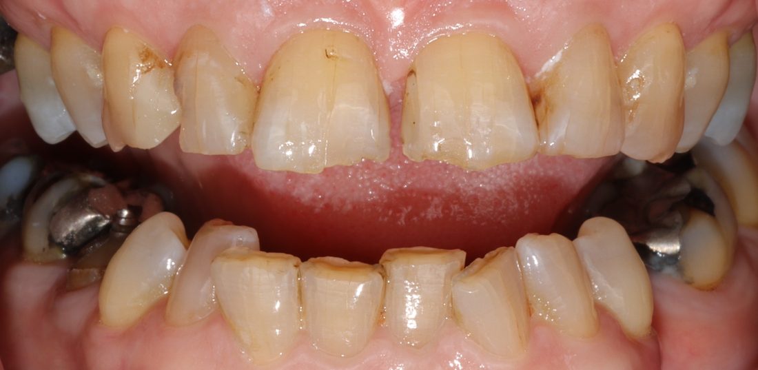Full Mouth Rehabilitation — before (actual patient)