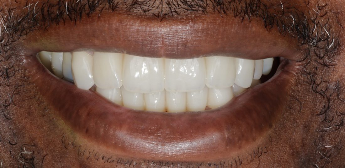 Implant Bridge — after (actual patient)