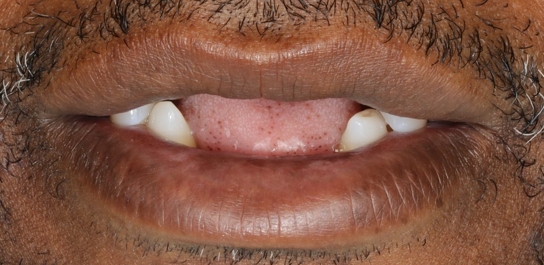 Implant Bridge — before (actual patient)