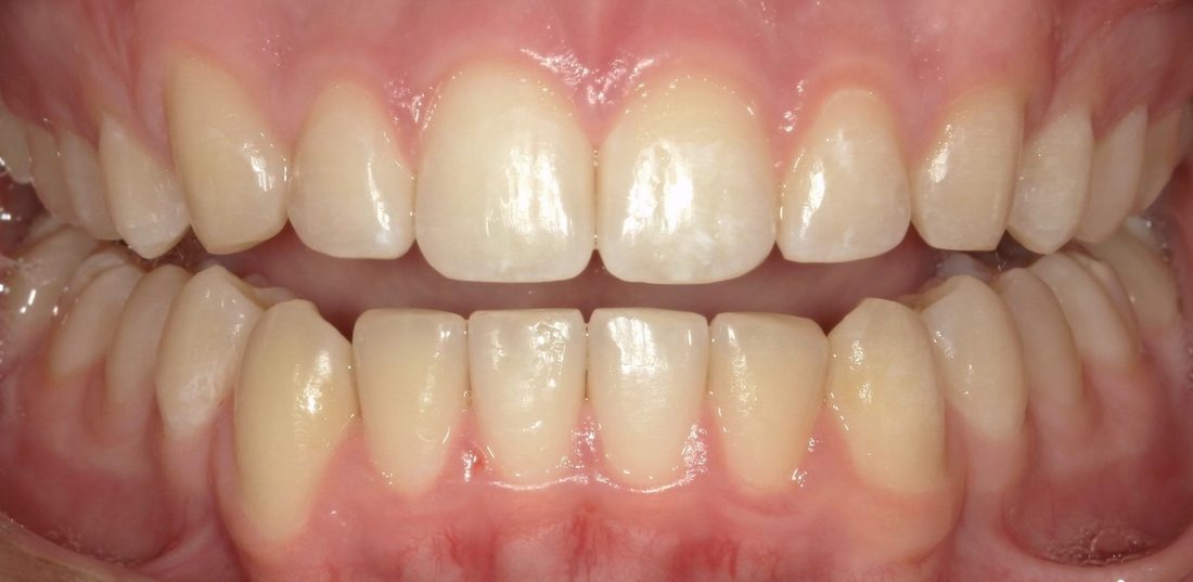 Invisalign — after (actual patient)