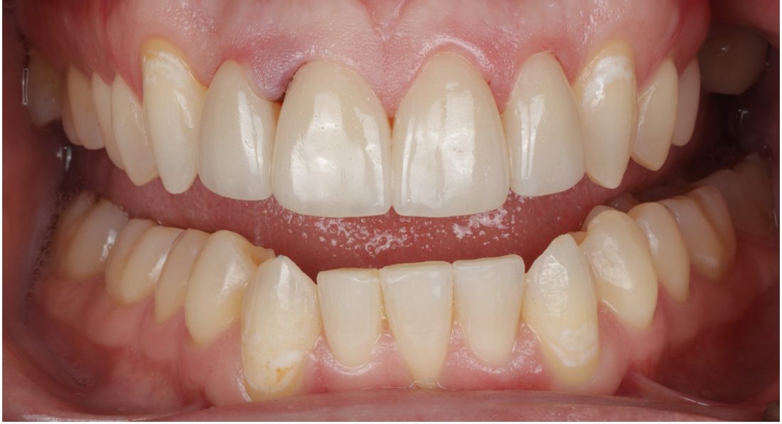 Invisalign and 4 Veneers — after (actual patient)