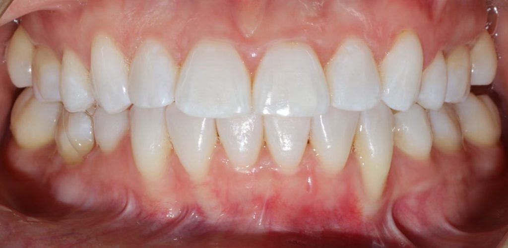 Invisalign and Whitening — after (actual patient)