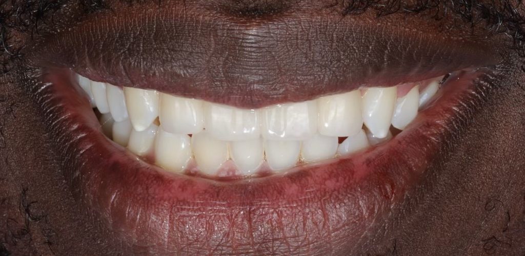 Porcelain Bridge — after (actual patient)