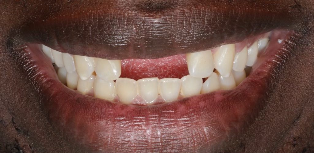 Porcelain Bridge — before (actual patient)