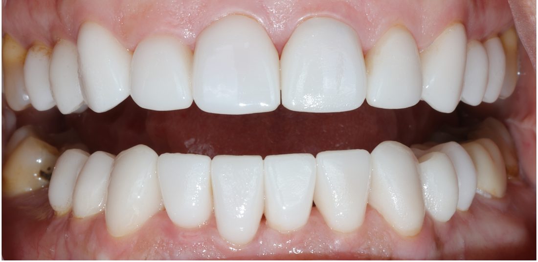 Tetracycline Staining — after (actual patient)