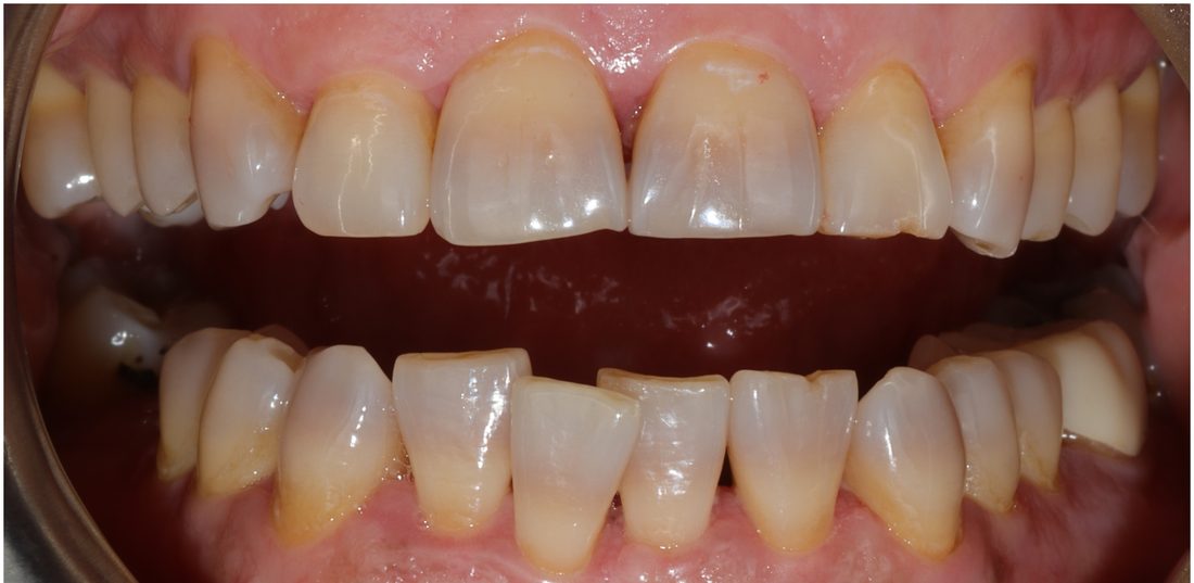 Tetracycline Staining — before (actual patient)